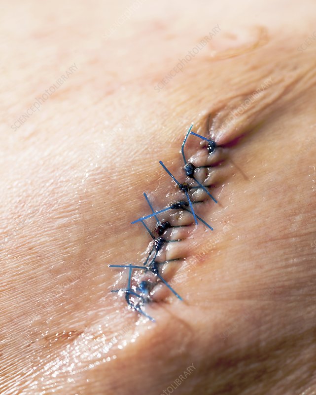 Suture removal at Lymphyx